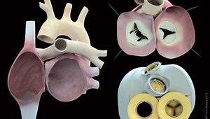 First patient receives next-generation artificial heart replacement