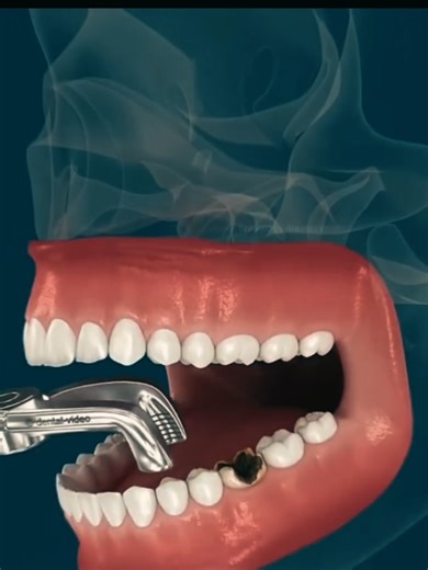 Understanding What Happens After Tooth Extraction