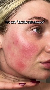 64K views · 345 reactions | Blush on your own terms with The Red Set! ✨ This two-step prescription treatment designed to treat rosacea, a skin condition that cause redness, inflammation, and acne-like bumps on the face. Formulated by dermatologists with clinically proven ingredients, so you can see results in as little as 2 months or your money back! Get started 100% online at Musely.com! | Musely | Facebook