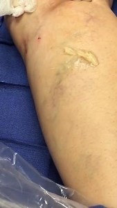 See the Procedure: Foam Sclerotherapy to Treat Veins on Legs
