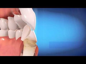 Invisalign- how does it work