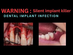 Dental Implant Infections: Early vs. Late Infections | Causes, Sign Symptoms & Treatment