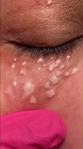 What are Syringomas? #eyetreatment #dermatologist #shorts