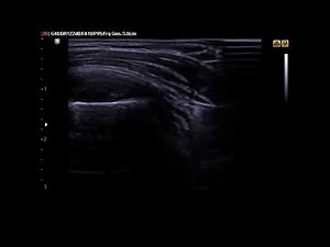 Ultrasound Guided Subacromial Bursa Injection