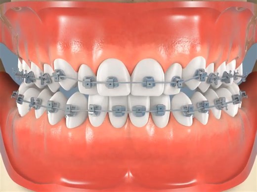 braces can correct crowding, rotations, spacing, open bite, crossbite, and jaw discrepancies by applying gentle pressure to move teeth and jaw positions into better alignment. | City dental clinic Byo