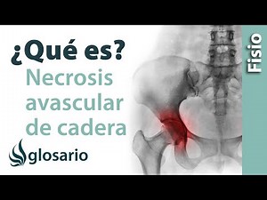 Avascular necrosis of the hip | What is it?