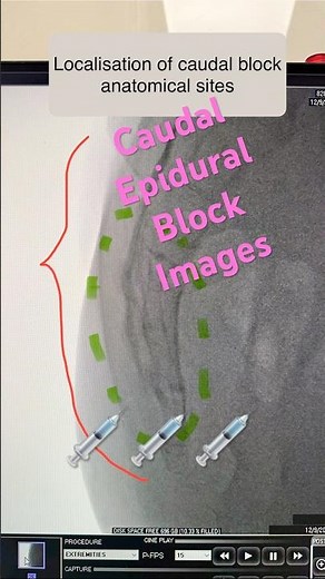 ‘Caudal epidural block’ in images| a fluroscopic overview| #anaesthesia #epidural #caudalepidural