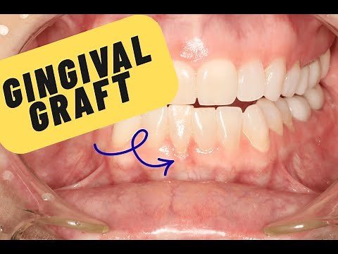 Have You Been Told You Need A Gum Graft? Watch this LIVE DEMONSTRATION of a Free-Gingival Graft.
