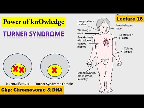 Turner Syndrome | Chromosomal Disorder | Lecture 16