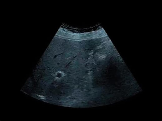 Radiology @all abnormalities 🥏🥏 on Instagram: "PORCELAIN GALLBLADDER Definition Porcelain gallbladder is a condition characterized by calcification of the gallbladder wall, usually due to long-standing chronic cholecystitis associated with gallstones. The gallbladder wall appears hyperechoic with dense posterior acoustic shadowing on ultrasound, resembling porcelain. ULTRASOUND REPORT Clinical Presentation Progressive right upper quadrant pain with nausea and vomiting. History of chronic inter