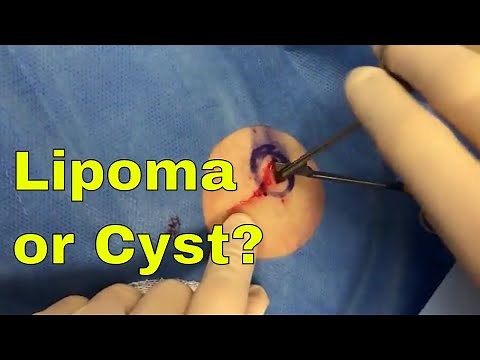 Lipoma or Cyst? What do you think? Upper Back Growth, Good Squeeze and Pop