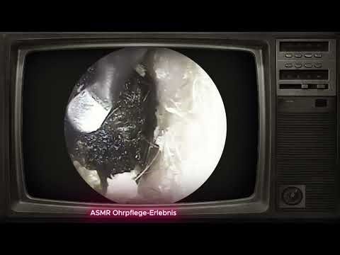 😴Deep Ear Wax Removal & Cleaning (Satisfying ASMR)