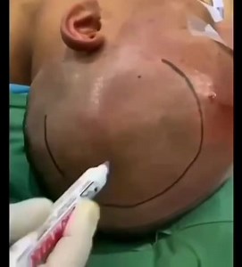 Massive Bloodclots Extruded From Man's Brain