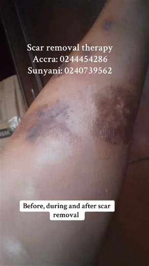 The way to go when it comes to scar removal #gainsongains #gainwiththeepluto #gainparty #gaintrains #gainwithpaula #gaineithmchina | Dais Beauty Spa & Skincare