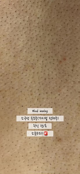 소극성 속모증(가시털 정체증) 왁싱 전/후! #왁싱 #왁싱샵 #강남왁싱 #선릉왁싱 #브라질리언왁싱 #브라질리언 #다리왁싱 #등왁싱 #팔왁싱 #웨딩왁싱 #바프왁싱 #청소년왁싱 #스킨플래닝 #패디플래닝 #속모증 #가시털