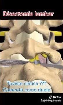Cirugía de Hernia Discal