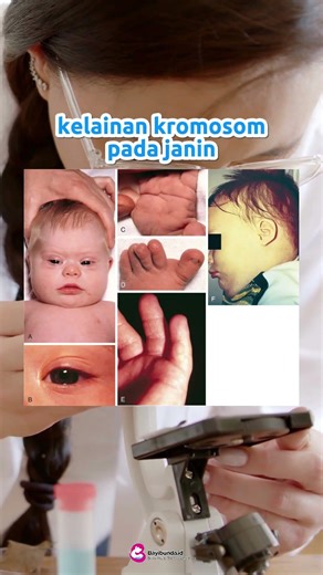 NIPT | TES KELAINAN GENETIK | DOWN SYNDROM | BAYI