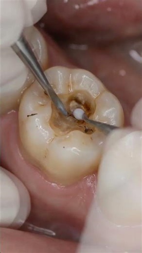 Deep Occlusal Decay in Lower Molar