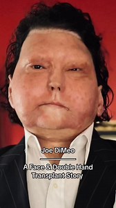 A face and double hand transplant story that changed our lives forever. Joe’s book is almost finished—sharing his journey of resilience, love, and hope. Stay tuned, more to come! | Dimeo Joe