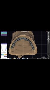 Design full arch on Bar by Exocad | Duong Exocad