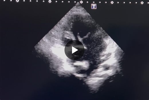 #echocardiography #congenitalheartdisease #fontancirculation #singleventricle #pediatriccardiology #cardiacimaging | Şeyma K.