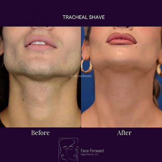 Tracheal Shave| Before and After| Adam's Apple Reduction