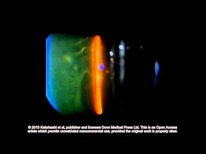 Classification of posterior vitreous detachment ID 54021 Supplementary video 6