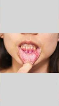 Mouth Cancer Part 2 | Diagnosis, Biopsy & Treatment Options Explained by Dr Girish Raoy