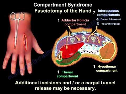 Compartment Syndrome Of The Hand & Finger