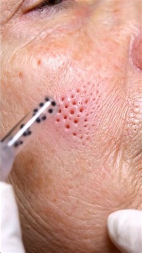 Giant Blackhead POP — So Satisfying to Watch