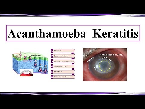 Acanthamoeba Keratitis
