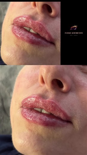 Lumi Pro Lip Booster, Your lips but better!🤩 Book your consultation by DM now🔥 #lumiprolipbooster #lumipro #lipbooster #lipenhancements #notfiller #nofilter