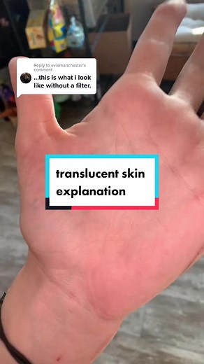 Ehlers Danlos Translucent Skin: A Closer Look at Translucency