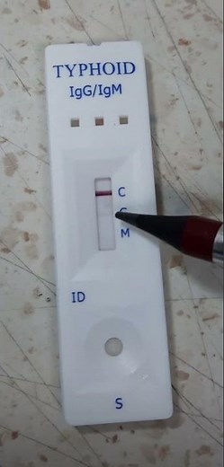 Typhoid IgG/IgM Rapid Test shows Positive IgG.