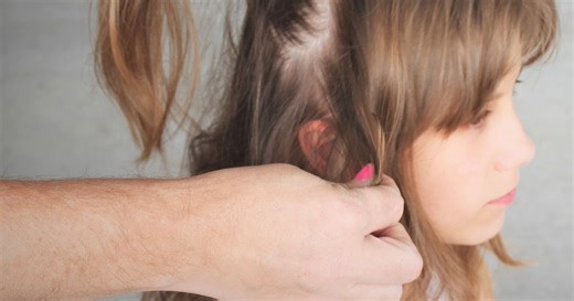 Head lice rules and whether you can send your kids to school if they have nits