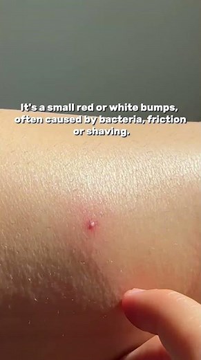 Folliculitis Explained: Those Red Bumps Nobody Talks About