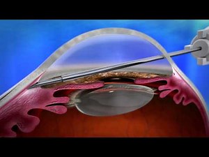 XEN Glaucoma Implant • Video • MEDtube.net