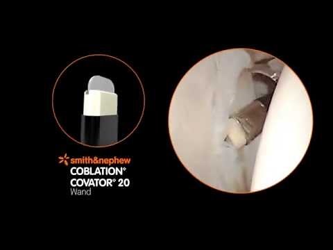COBLATION◊ Module 2 - Clinical Applications of COBLATION