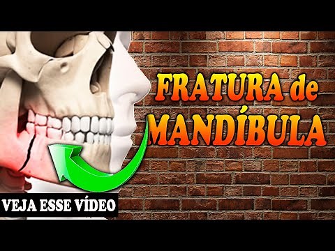 TRATAMENTO PARA Fratura Mandibular | Fratura do Maxilar Inferior - Fisioterapia