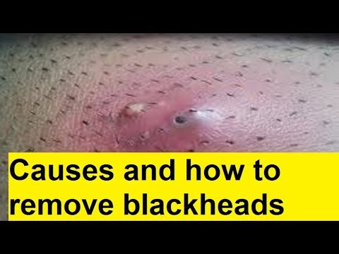 Causes and how to remove blackheads