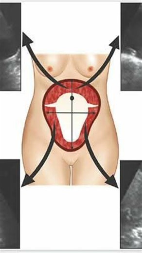 how to measure AFI fluid in ultrasound#sonography #pregnant#baby #ultrasound#health #ultrasoundguide