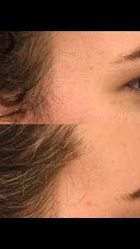 Brow Bossing Reduction Types 1 & 3 | Dr. Rodman in Houston TX