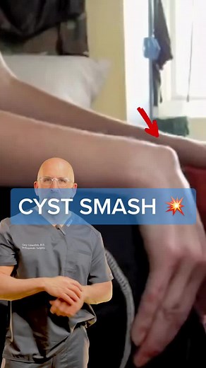 Ganglion Cyst Smash Compilation