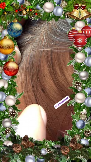#lice #licetreatment #liceasmr #hair #liceremoval