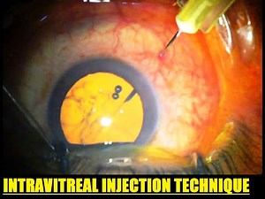 INTRAVITREAL INJECTION TECHNIQUE