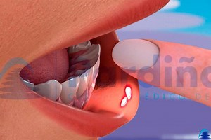 Mouth Ulcers - What Is A Canker Sore, Causes And Treatment