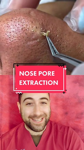 Proper Aseptic Technique for Nose Pore Extraction