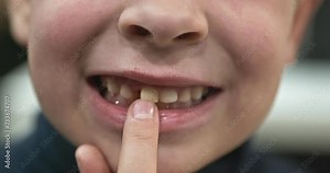 Kid Boy Shows Wobbly Loose Milk Baby Tooth. Child Wobbling Tooth with Hand Fingers. 4K 10-bit