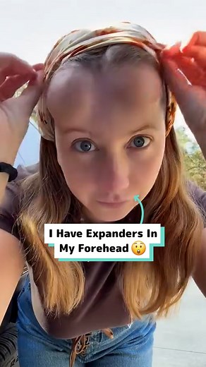 216K views · 97 reactions | I had expanders put in my forehead  | Craft Factory | Facebook