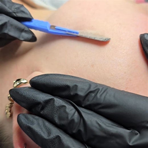 Dermaplane. Using a sterile blade we gently exfoliate the dead skin and remove fine vellum hair ("peach fuzz"). Benefits and reasons to having Dermaplane. 💙 Instantly smoother, brighter skin with improved texture and radiance. 💙 Enhances skincare absorption and gives makeup a flawless, even finish. 💙 Can help reduce the look of fine lines and minor acne scares over time. Advised every 4-6 weeks (aligned with natural cell turnover cycle). | The beauty bar